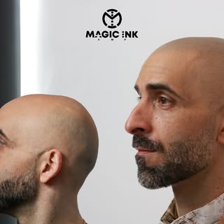 3 MONTHS HEALED SMP treatment. Amazing client struggled with Alopecia Areata hair loss, Not anymore 