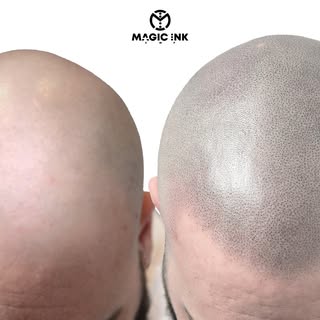 Check out this transformation! After 3 SMP sessions a natural realistic hairline was the goal for th