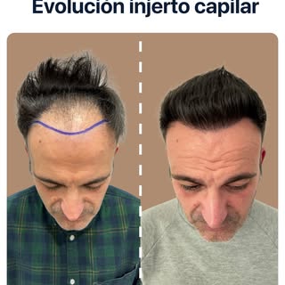 Una imagen vale más que mil palabras. 

Observad la densidad conseguida en la zona frontal. Nuestro 
