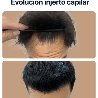 Ver este antes y después es ver años de confianza recuperados. 

En Clínica Jacobovski nos especiali