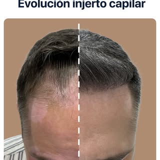 El secreto de un buen trasplante no es solo que el pelo crezca, sino que parezca que siempre estuvo 