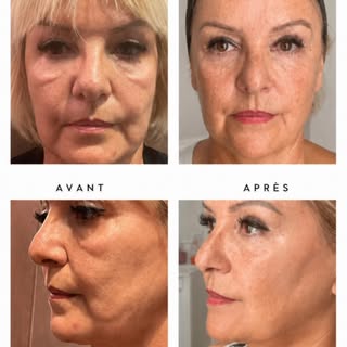 ✨ DOUBLE NEEDLE — LIFT SANS CHIRURGIE
Résultats 1 an après 

Une technique ciblée pour redessiner l’
