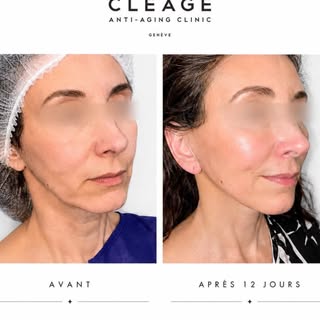 ✨ Lifting du visage : retrouver l’harmonie, sans changer de visage.

Le lifting du visage ne consist