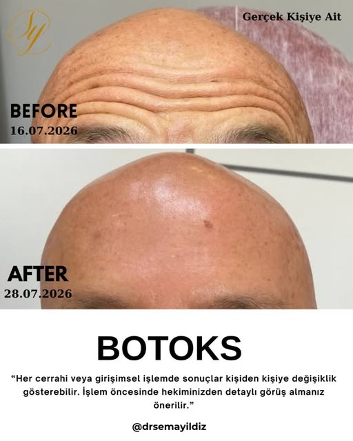 Estetik ve Kozmetik Uygulamalar
.
Sadece bilgilendirme amaçlıdır, tanı ve tedavi için mutlaka doktor