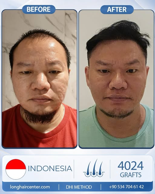 Don’t let hair loss become a reason to feel insecure or lose confidence. There are effective solutio