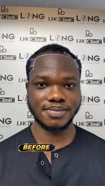 Do You Have Afro-Textured Hair and Are Considering a Hair Transplant?

Afro-textured hair can achiev