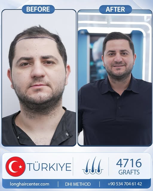 Presenting a result that can inspire you to consider a hair transplant if you are struggling with se