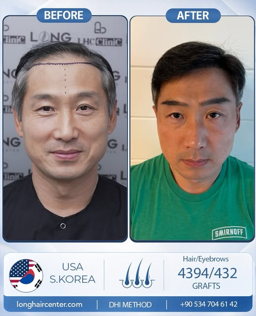 Presenting another remarkable hair and eyebrow transplant transformation by Long Hair Center.
Our pa