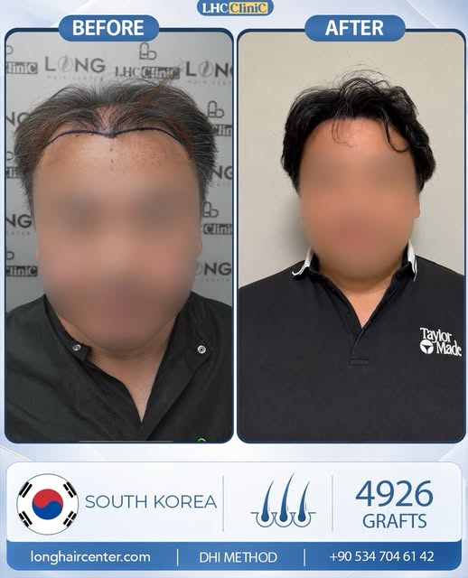 A new hairline, stronger coverage, and a transformation designed to look naturally his own.

This pa