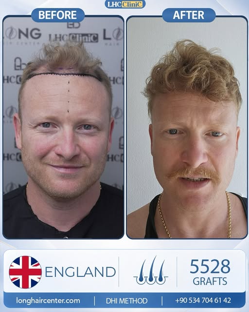 Crown Hair Transplant Result:
Mr. Thomas was struggling with hair loss in both his crown and frontal