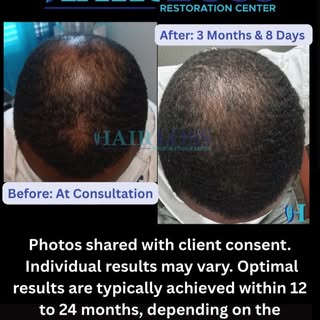 3 Month Progress

#Barbers #hairlosshelp #hairrestoration #malepatternbaldness #malehairloss