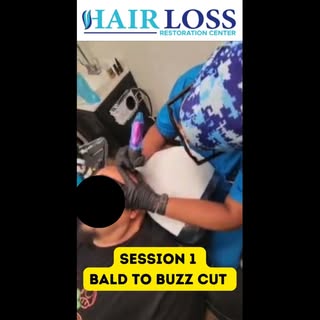 SMP: Another Non-Surgical Solution for Male Pattern Hair Loss