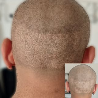 Scarred tissues from hair transplant, 1 Session transplant scar blend ✔️ 😃
-
-
-
💬Are you bald or 