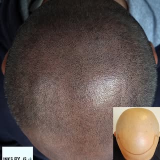 Difficult does not mean impossible 🤙
-
-
-
💬Are you bald or have Thinning hair?
💬Do you want to g