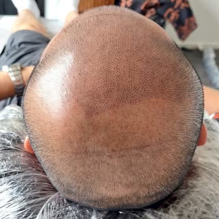 2 Session, Crispy new hair follicles 🤌
-
-
-
💬Are you bald or have Thinning hair?
💬Do you want to