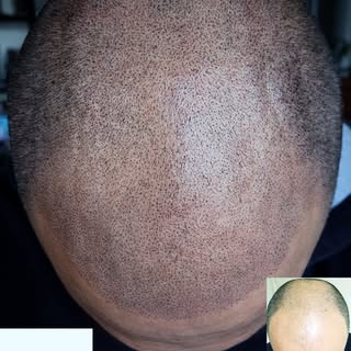 Redness is normal during treatment and depending on the persons skin can be between an hour to a few