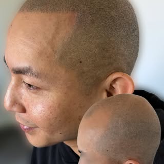 Reconstruction of the hairline achieved and some density on the crown area😎
-
-
-
💬Are you bald or