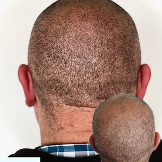 An amazing balding crown transformation from Scalp Micropigmentation 🤙
-
-
-
💬Are you bald or have