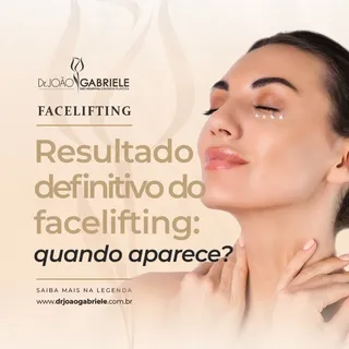 O resultado do facelifting não aparece de forma imediata — ele evolui.

Nos primeiros dias e semanas