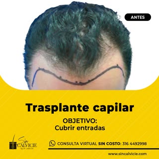 Las entradas son áreas de la cabeza que en muchos casos presentan calvicie temprana, dándole al paci