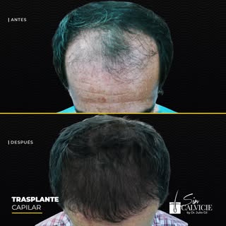 La calvicie es una condición que puede hacerte ver mayor. A este paciente le implantamos aproximadam
