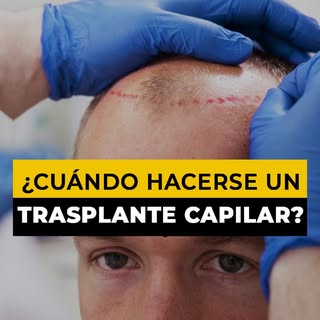 Cuando decidas hacerte un trasplante capilar, en Sin Calvicie by Dr. Julio Gil estamos listos con to