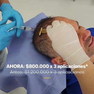 💆‍♂️💉 ¡Recupera la vitalidad de tu pelo con nuestra mesoterapia capilar! En Sin Calvicie by Dr. Ju
