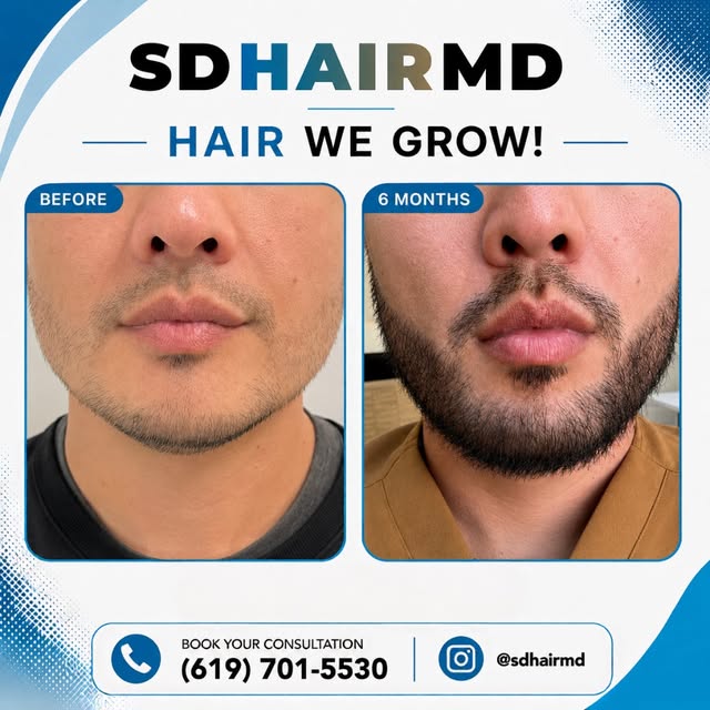 6 months later… the facial hair glow-up is real. 🔥

From sparse growth to a fuller, more defined lo