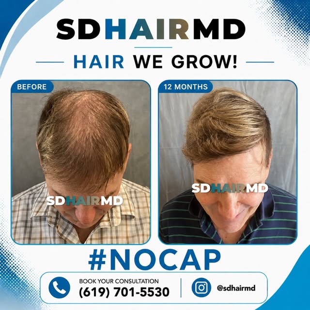 12 months can make a big difference. 👏 From thinning hair to stronger, fuller-looking coverage, thi