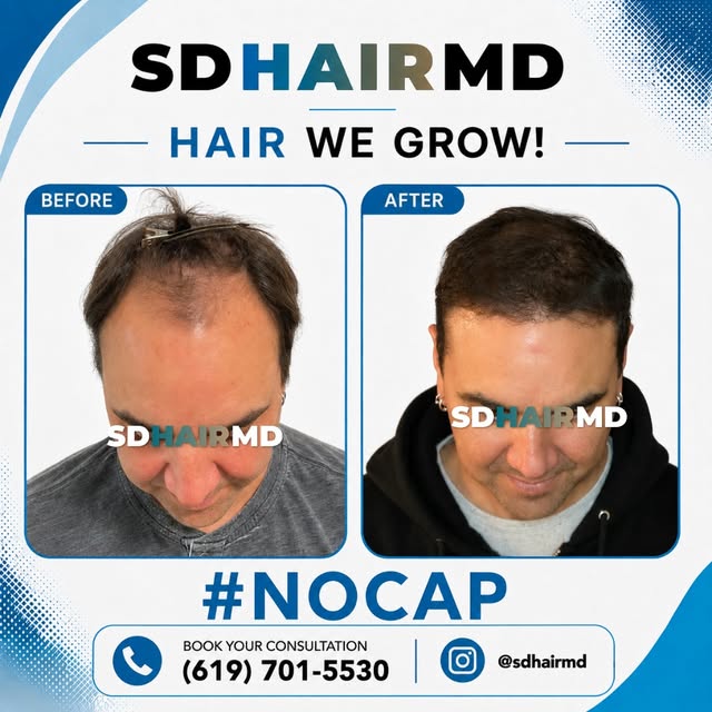 9 months later… the comeback is looking strong. 🔥

From a receding hairline to fuller, natural-look
