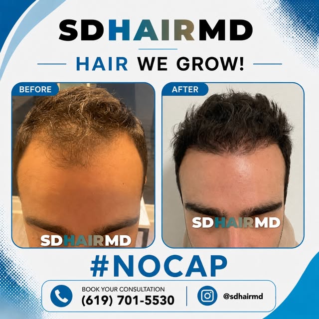This 6 month hair transformation is a perfect example of how the right hair restoration plan can hel