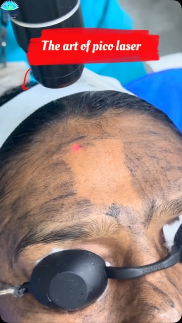 Pico laser treatment call:72002 00751 @smaavins #chennai #vadapalani #trending #viralreels #skintrea