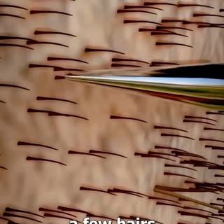 How Do Hair Transplants Work 🤨?? 
.
Follow me for more detailed and amazing facts about hair transp