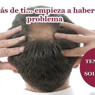 #caidadepelo #solucion #tratamientocapilares