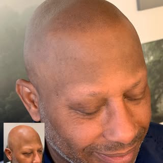 Subtle, natural, undetectable SMP designed to frame the face and restore confidence without surgery 