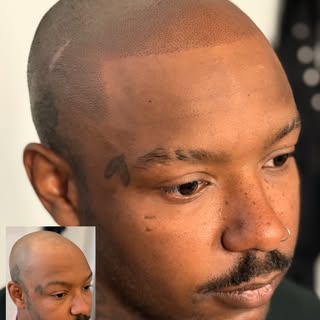 💈 A clean, shaved look has become a modern staple in men’s style. Scalp Micropigmentation helps com