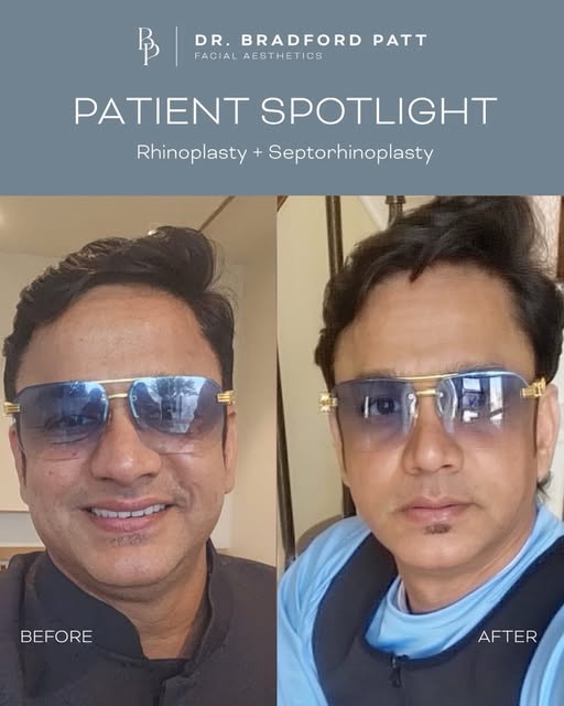 A more defined tip, while still looking completely natural. 👃

This patient shared a selfie from be