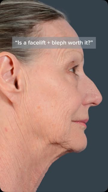 No pen and paper. Just a little facial rejuvenation. 👀✨

This patient underwent a deep plane faceli