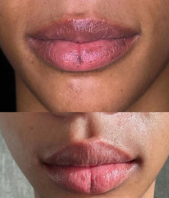 One month later and these lips are noticeably brighter and smoother 
✅ custom chemical peel targets 