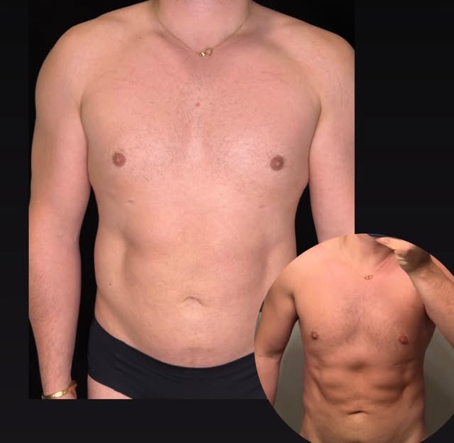 Meet truSculpt® Body Contouring — a non-invasive treatment that uses controlled radiofrequency heat 
