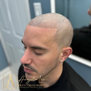 ✨ Scalp Micropigmentation SMP Restore Your Hairline, Boost Your Confidence ✨

Hair thinning isn’t ju