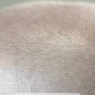 ✨ Transform your look with Scalp Micropigmentation (SMP) ✨

At Winter Park SMP, every procedure is t