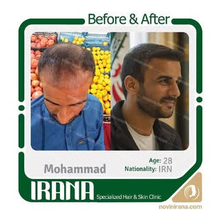 Hair Transpalent With Painless Local Anesthesia in Mashhad, Iran 
Fit Hair Transpalent , Maximum gra