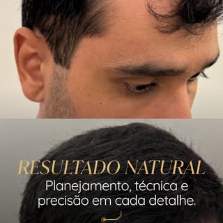Naturalidade é o principal objetivo de um bom transplante capilar.

Neste antes e depois, cada detal