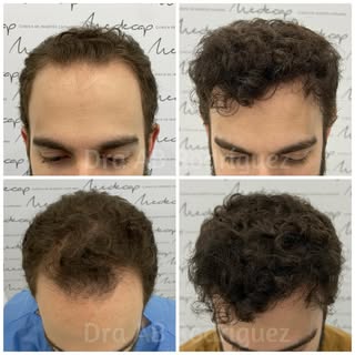Antes/después tras 2 años de la cirugía de injerto capilar realizada por Dra Ana Belén R en @clinica