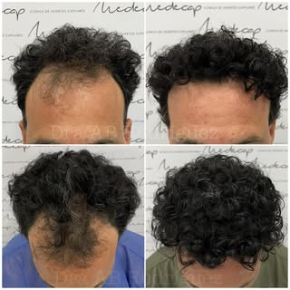 Antes/después tras año y medio de la cirugía de injerto capilar realizada por @dranabelenrodriguez y