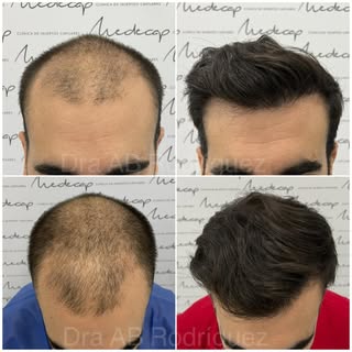 Antes/después a los 12 meses de la cirugía de #injertocapilar 

Paciente joven con alopecia avanzada