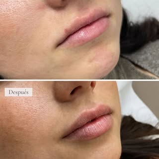 Unos labios bonitos no siempre necesitan más volumen, sino el equilibrio perfecto. 

En este caso tr