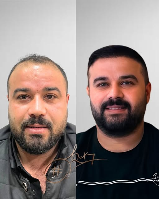 ✨ Değişim net, sonuç doğal.

Kişiye özel saç çizgisi ve dengeli yoğunlukla planlanan saç ekimi sürec