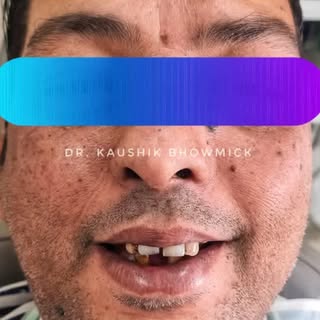 From broken and missing to a confident smile transformation. 
Full mouth rehabilitation designed for